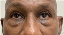 Eyelid Surgery Before Photo by Camille Cash, MD; Houston, TX - Case 48034