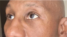 Eyelid Surgery After Photo by Camille Cash, MD; Houston, TX - Case 48034