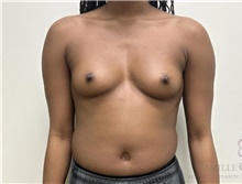 Breast Augmentation Before Photo by Camille Cash, MD; Houston, TX - Case 48256