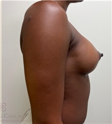 Breast Augmentation After Photo by Camille Cash, MD; Houston, TX - Case 48256