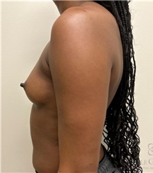Breast Augmentation Before Photo by Camille Cash, MD; Houston, TX - Case 48256
