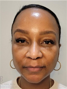 Laser Skin Resurfacing After Photo by Camille Cash, MD; Houston, TX - Case 48348