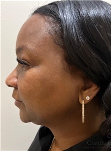 Laser Skin Resurfacing Before Photo by Camille Cash, MD; Houston, TX - Case 48348