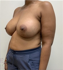 Breast Augmentation After Photo by Camille Cash, MD; Houston, TX - Case 48351