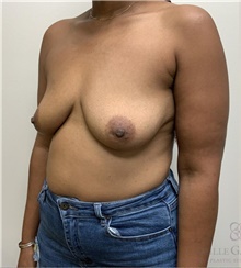 Breast Augmentation Before Photo by Camille Cash, MD; Houston, TX - Case 48351