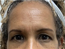 Eyelid Surgery Before Photo by Camille Cash, MD; Houston, TX - Case 48439
