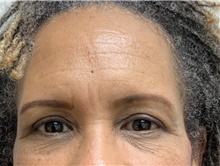 Brow Lift After Photo by Camille Cash, MD; Houston, TX - Case 48440