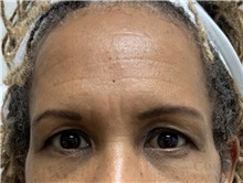 Brow Lift Before Photo by Camille Cash, MD; Houston, TX - Case 48440