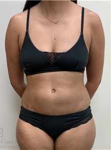 Tummy Tuck After Photo by Camille Cash, MD; Houston, TX - Case 48441