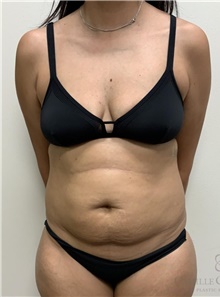 Tummy Tuck Before Photo by Camille Cash, MD; Houston, TX - Case 48441