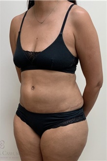 Tummy Tuck After Photo by Camille Cash, MD; Houston, TX - Case 48441