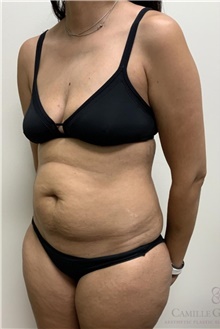 Tummy Tuck Before Photo by Camille Cash, MD; Houston, TX - Case 48441