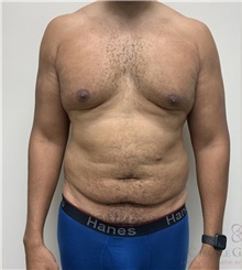 Tummy Tuck Before Photo by Camille Cash, MD; Houston, TX - Case 48624