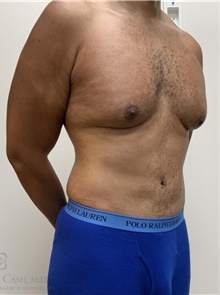 Tummy Tuck After Photo by Camille Cash, MD; Houston, TX - Case 48624