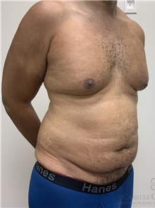 Tummy Tuck Before Photo by Camille Cash, MD; Houston, TX - Case 48624