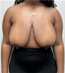 Breast Reduction Before Photo by Camille Cash, MD; Houston, TX - Case 49167