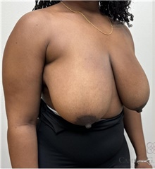 Breast Reduction Before Photo by Camille Cash, MD; Houston, TX - Case 49167