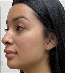 Dermal Fillers After Photo by Camille Cash, MD; Houston, TX - Case 49169