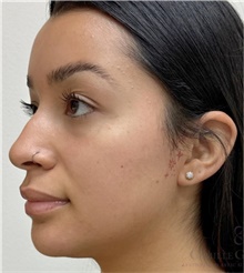 Dermal Fillers Before Photo by Camille Cash, MD; Houston, TX - Case 49169