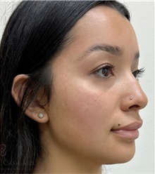 Dermal Fillers After Photo by Camille Cash, MD; Houston, TX - Case 49169