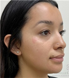 Dermal Fillers Before Photo by Camille Cash, MD; Houston, TX - Case 49169