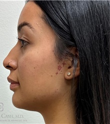 Dermal Fillers After Photo by Camille Cash, MD; Houston, TX - Case 49169