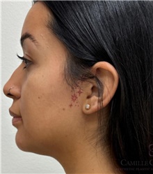 Dermal Fillers Before Photo by Camille Cash, MD; Houston, TX - Case 49169