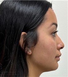 Dermal Fillers After Photo by Camille Cash, MD; Houston, TX - Case 49169