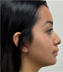 Dermal Fillers Before Photo by Camille Cash, MD; Houston, TX - Case 49169