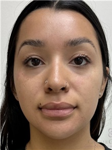 Dermal Fillers Before Photo by Camille Cash, MD; Houston, TX - Case 49169