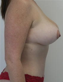 Tummy Tuck After Photo by John Thomassen, MD; Fort Lauderdale, FL - Case 20713