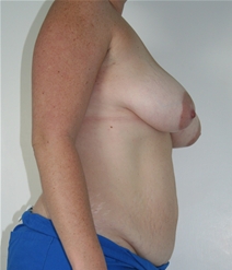 Tummy Tuck Before Photo by John Thomassen, MD; Fort Lauderdale, FL - Case 20713