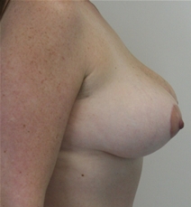 Breast Lift After Photo by John Thomassen, MD; Fort Lauderdale, FL - Case 20714