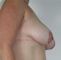 Breast Lift Before Photo by John Thomassen, MD; Fort Lauderdale, FL - Case 20714