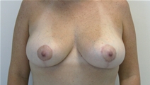 Breast Lift After Photo by John Thomassen, MD; Fort Lauderdale, FL - Case 20714