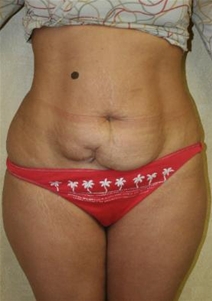 Tummy Tuck Before Photo by John Thomassen, MD; Fort Lauderdale, FL - Case 20746