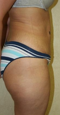 Tummy Tuck After Photo by John Thomassen, MD; Fort Lauderdale, FL - Case 20746