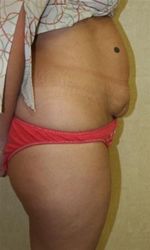 Tummy Tuck Before Photo by John Thomassen, MD; Fort Lauderdale, FL - Case 20746