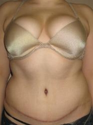 Tummy Tuck After Photo by John Thomassen, MD; Fort Lauderdale, FL - Case 20748