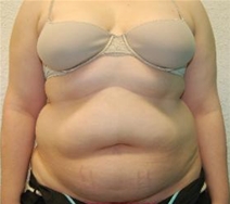 Tummy Tuck Before Photo by John Thomassen, MD; Fort Lauderdale, FL - Case 20748