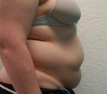 Tummy Tuck Before Photo by John Thomassen, MD; Fort Lauderdale, FL - Case 20748