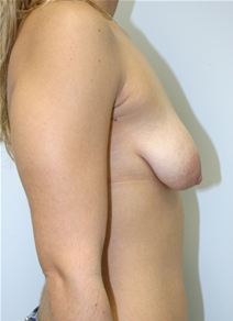 Breast Augmentation Before Photo by John Thomassen, MD; Fort Lauderdale, FL - Case 20749