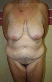 Body Contouring Before Photo by John Thomassen, MD; Fort Lauderdale, FL - Case 20750