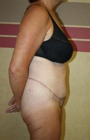 Body Contouring After Photo by John Thomassen, MD; Fort Lauderdale, FL - Case 20750