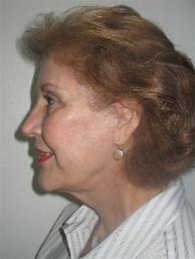 Facelift After Photo by John Thomassen, MD; Fort Lauderdale, FL - Case 20779