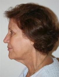 Facelift Before Photo by John Thomassen, MD; Fort Lauderdale, FL - Case 20779