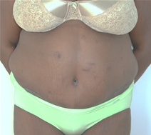 Body Contouring After Photo by John Thomassen, MD; Fort Lauderdale, FL - Case 20780