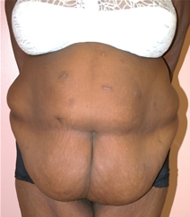 Body Contouring Before Photo by John Thomassen, MD; Fort Lauderdale, FL - Case 20780