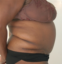 Body Contouring After Photo by John Thomassen, MD; Fort Lauderdale, FL - Case 20780