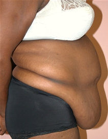 Body Contouring Before Photo by John Thomassen, MD; Fort Lauderdale, FL - Case 20780